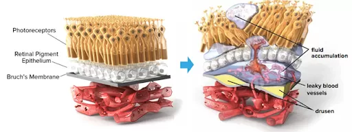 an illustration of leaky blood vessel in wet AMD