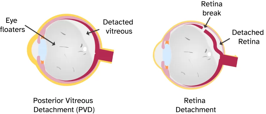 an illustration PVD and RD