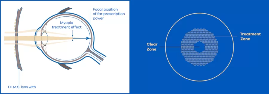 an illustration of DIMS technology