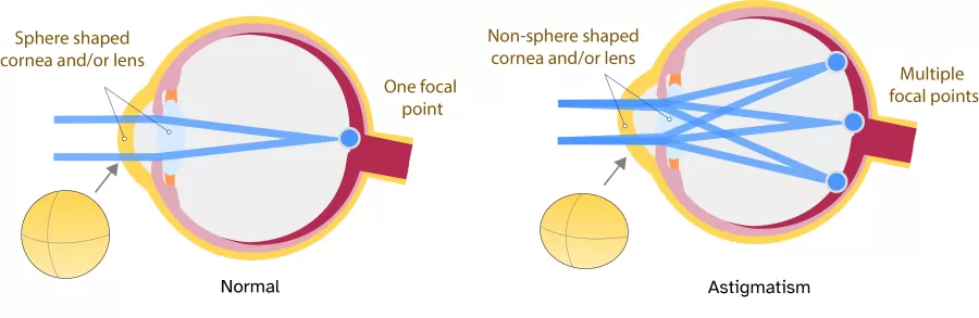 an illustration of astigmatism