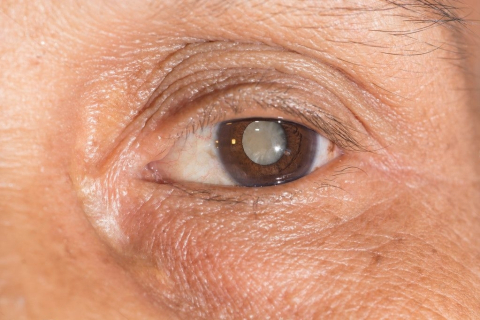 An image of an eye with cataract